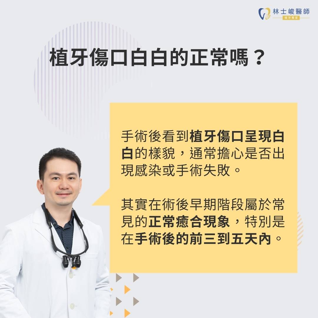 植牙傷口白白的是正常的嗎?傷口癒合過程與植牙傷口發炎警訊完整解析 1 植牙傷口白白的正常嗎?