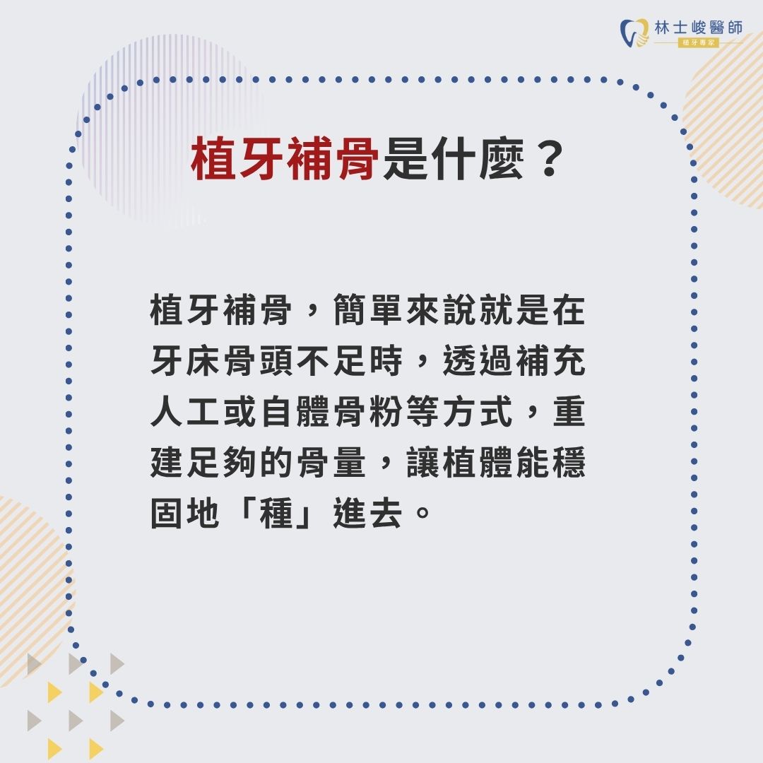 植牙補骨費用怎麼算?搞懂項目與價格差異,避免植牙補骨術亂收費 1 植牙補骨是什麼