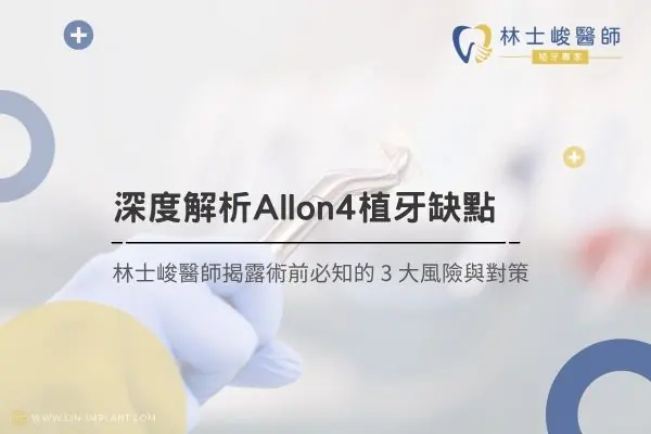 深度解析 All on 4 植牙缺點：林士峻醫師揭露術前必知的 3 大風險與對策